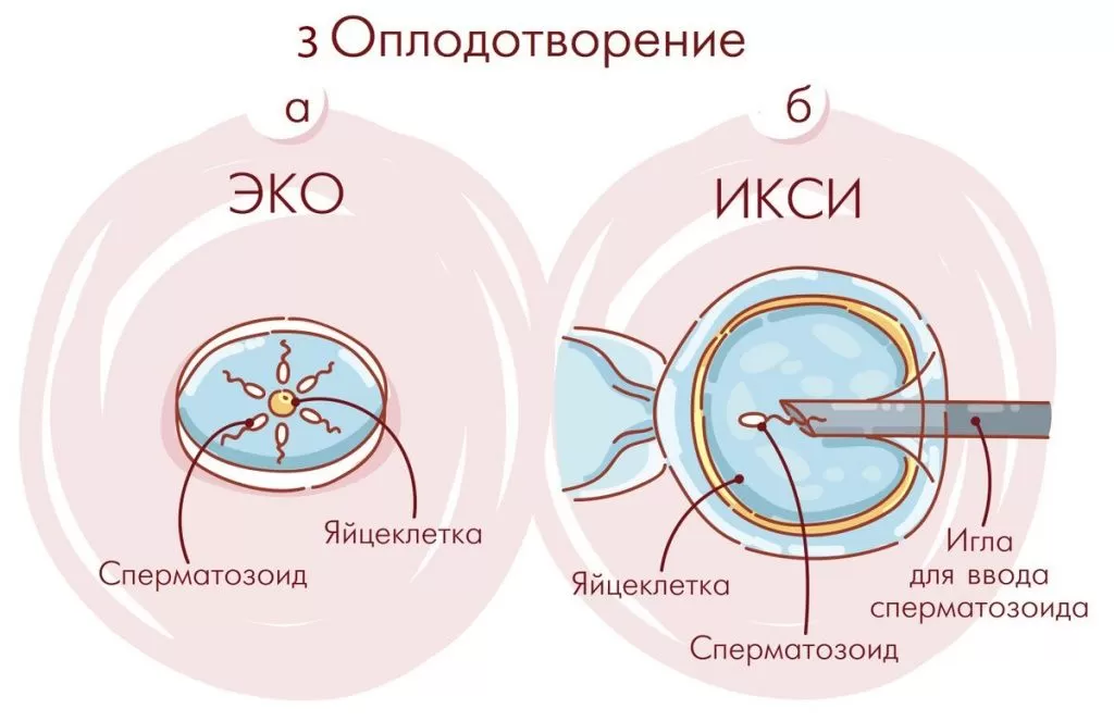 Причины бесплодия у мужчин